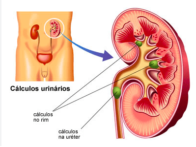 cálculo urinário